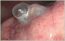 穴の開いている肺嚢胞の写真