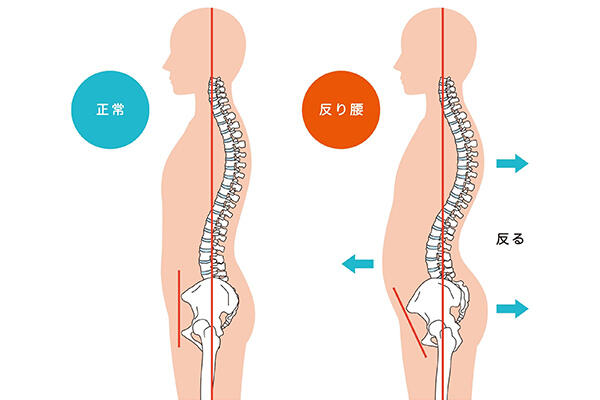 反り腰とは