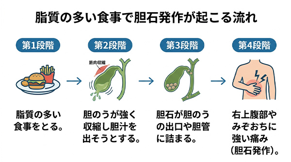 脂質の多い食事で胆石発作が起こる流れ