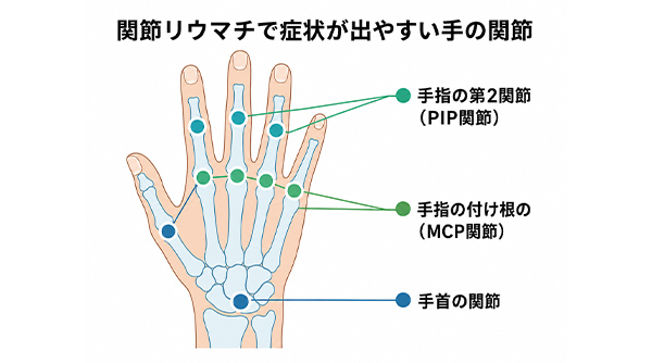 関節リウマチで症状が出やすい手の関節