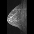 乳腺MRI検査
