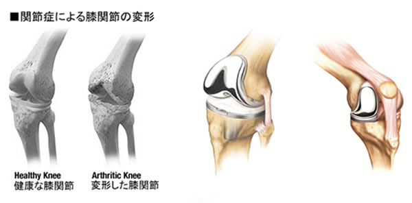 関節症による膝関節の変形