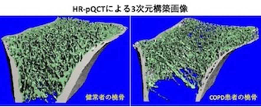 HR-pQCTによる3次元構築画像